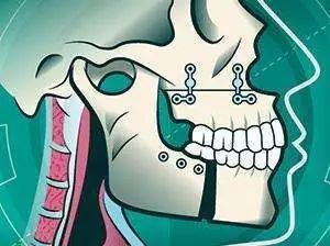 牙颌面畸形的正颌外科治疗技术