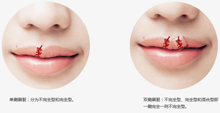 唇腭裂畸形序列治疗技术